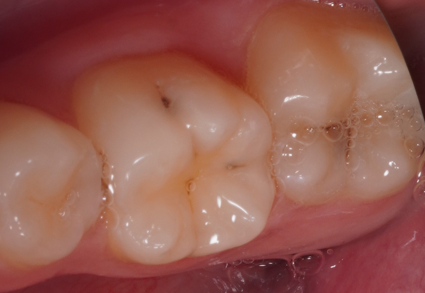 Фото до процедуры Лупушару 3