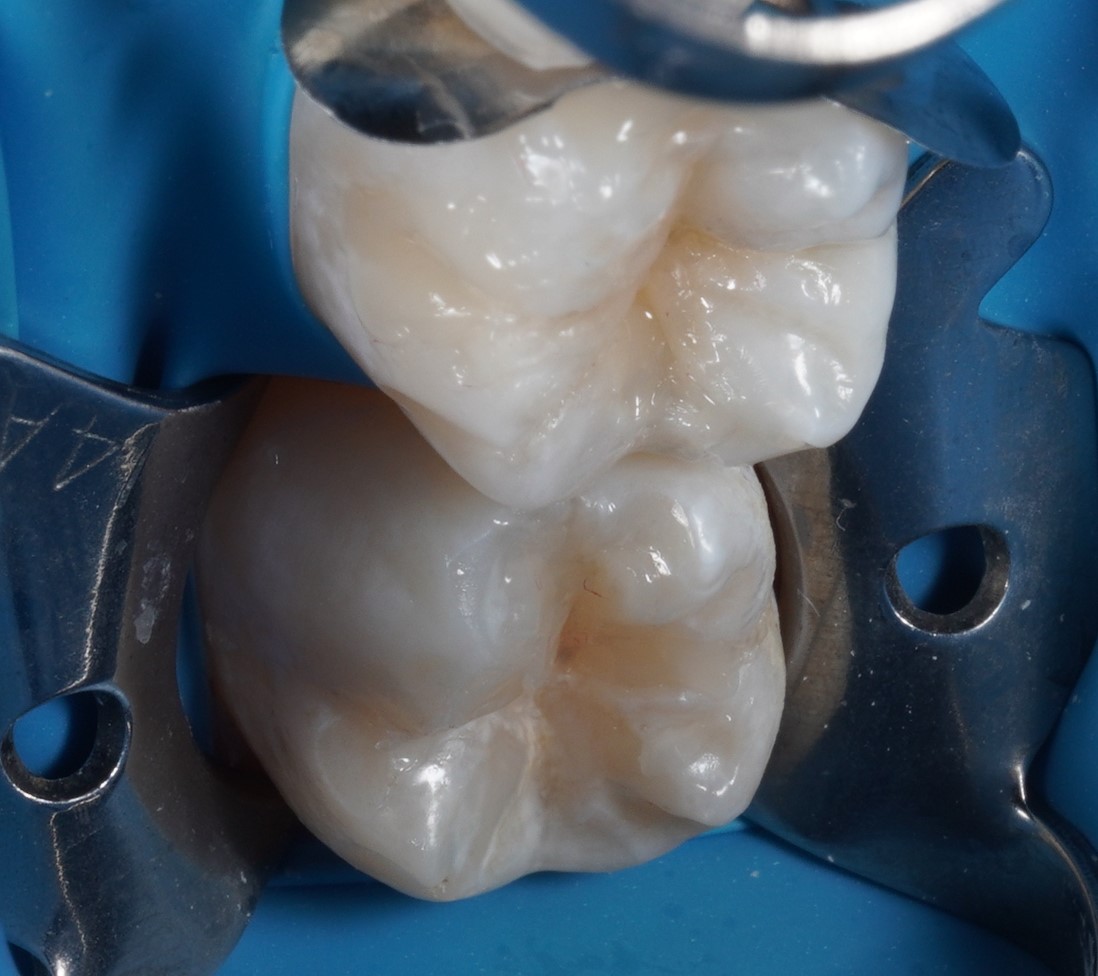 Фото после процедуры Лупушару 3