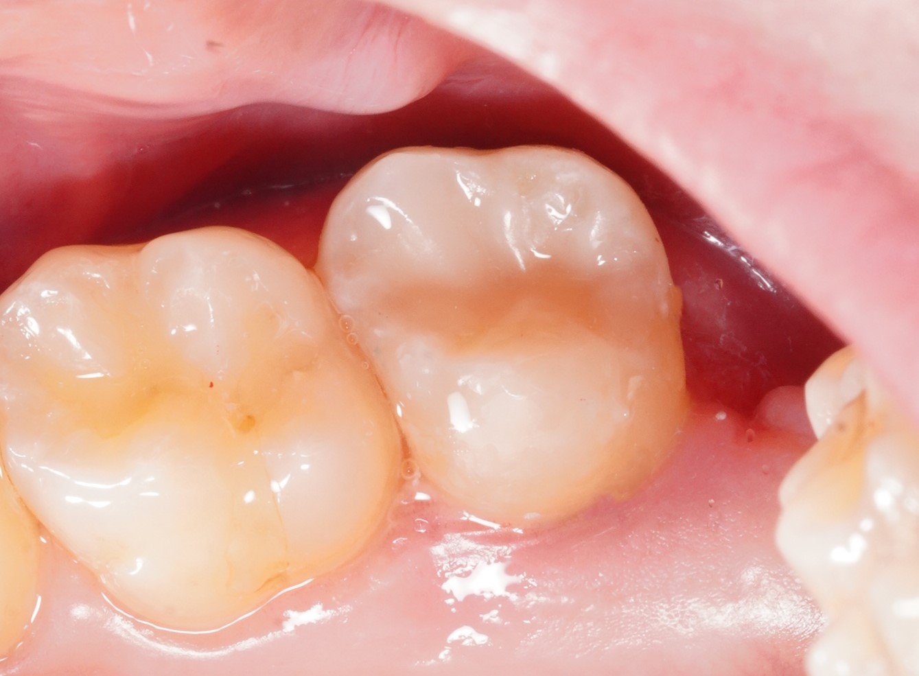 Фото после процедуры Лупушару 4