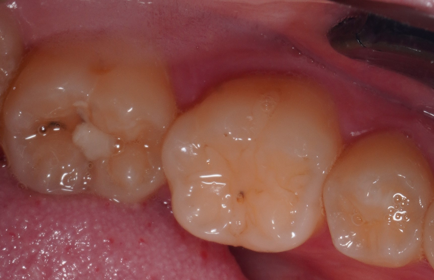 Фото до процедуры Лупушару 2