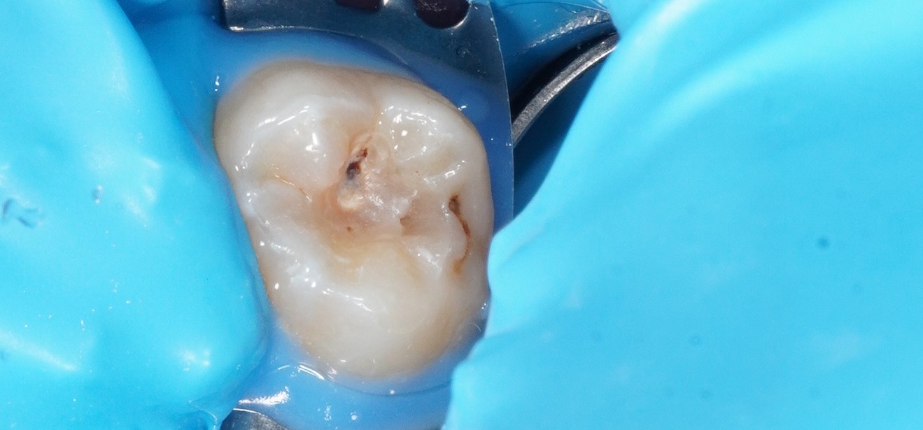 Фото до процедуры Лупушару 4