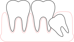 Удаление зубов мудрости при их аномальном расположении