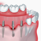 Базальная имплантация зубов