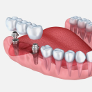 Имплантация жевательных зубов