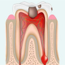 Лечение апикального периодонтита