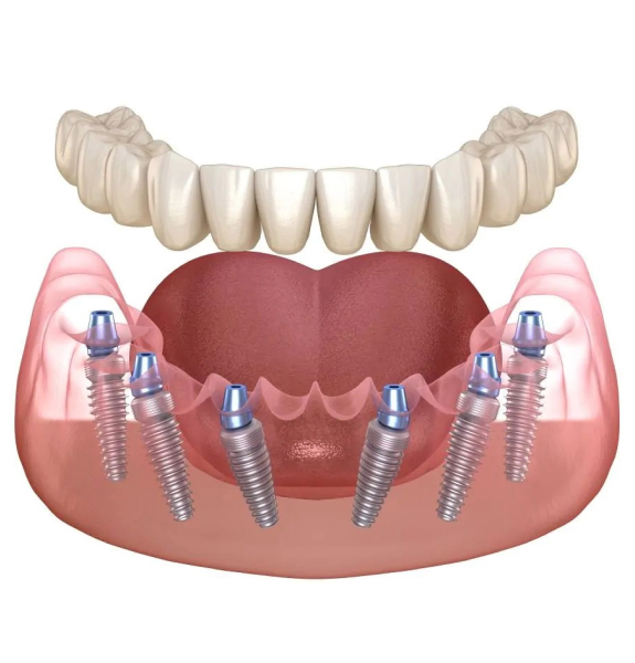 Имплантация All-on-6 в Санкт-Петербурге