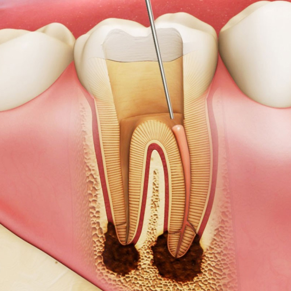 Кариес корня зуба в Санкт-Петербурге