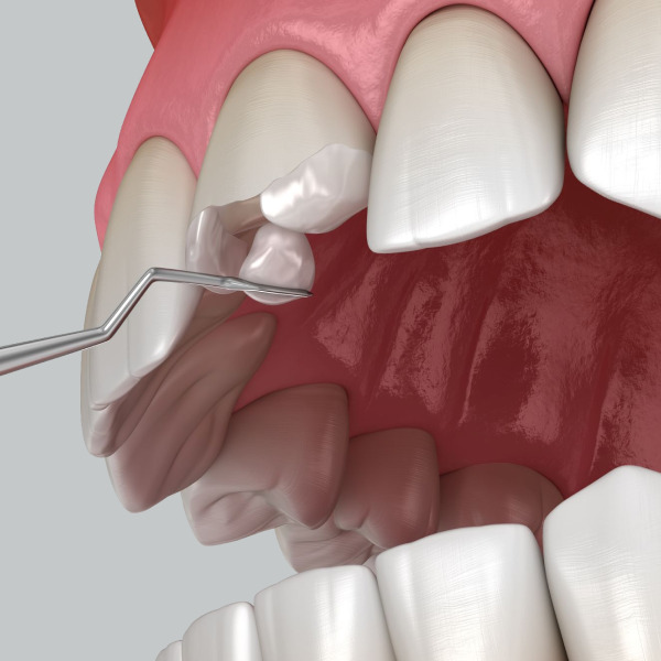 Непрямая реставрация зубов в Санкт-Петербурге